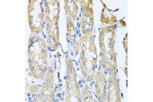 Immunohistochemistry of paraffin-embedded human gastric cancer using CCL3 antibody (ABIN5974742) at dilution of 1/100 (40x lens).