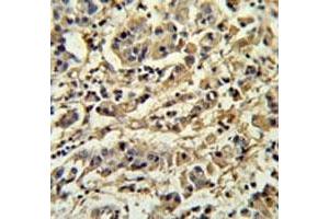 SIRT3 antibody IHC analysis in formalin fixed and paraffin embedded human breast carcinoma.