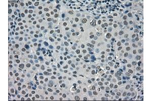 Immunohistochemical staining of paraffin-embedded Adenocarcinoma of ovary tissue using anti-SATB1mouse monoclonal antibody. (SATB1 anticorps)