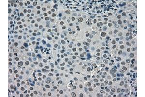 Immunohistochemical staining of paraffin-embedded Adenocarcinoma of ovary tissue using anti-SATB1mouse monoclonal antibody.