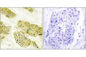 Immunohistochemistry analysis of paraffin-embedded human breast carcinoma tissue, using Collagen V alpha3 Antibody.