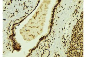 ABIN6269400 at 1/100 staining Human breast cancer tissue by IHC-P. (HDAC6 anticorps  (N-Term))