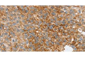 Immunohistochemistry of paraffin-embedded Human breast cancer tissue using SPARCL1 Polyclonal Antibody at dilution 1:30 (SPARCL1 anticorps)