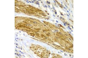Immunohistochemistry of paraffin-embedded human gastric cancer using CDK6 antibody. (CDK6 anticorps)