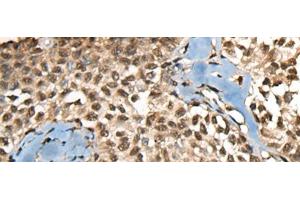 Immunohistochemistry of paraffin-embedded Human ovarian cancer tissue using CCDC12 Polyclonal Antibody at dilution of 1:60(x200) (CCDC12 anticorps)