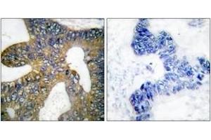Immunohistochemistry analysis of paraffin-embedded human colon carcinoma tissue, using HSP105 Antibody. (HSPH1 anticorps  (AA 791-840))