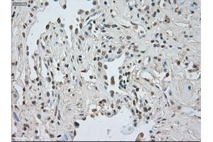 Immunohistochemical staining of paraffin-embedded Adenocarcinoma of breast tissue using anti-CTAG1B mouse monoclonal antibody.