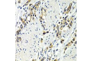 Immunohistochemistry of paraffin-embedded human gastric cancer using WNT3A antibody (ABIN6292349) at dilution of 1:200 (40x lens).