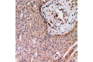 Immunohistochemical analysis of RAB24 staining in human breast cancer formalin fixed paraffin embedded tissue section. (RAB24 anticorps)
