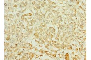 Immunohistochemistry of paraffin-embedded human pancreatic cancer using ABIN7164617 at dilution of 1:100 (TTLL2 anticorps  (AA 401-592))