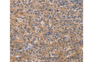 Immunohistochemistry of Human lung cancer using NCR2 Polyclonal Antibody at dilution of 1:60 (NKp44/NCR2 anticorps)