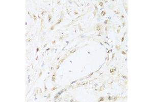 Immunohistochemistry of paraffin-embedded human gastric cancer using STAT1 antibody.
