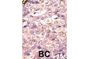 Formalin-fixed and paraffin-embedded human cancer tissue reacted with the primary antibody, which was peroxidase-conjugated to the secondary antibody, followed by AEC staining.