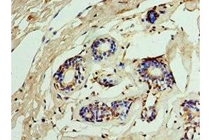 Immunohistochemistry of paraffin-embedded human breast cancer using ABIN7156290 at dilution of 1:100 (IMPDH2 anticorps  (AA 215-514))