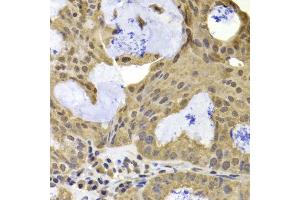 Immunohistochemistry of paraffin-embedded human oophoroma using TERF2IP antibody at dilution of 1:100 (40x lens). (RAP1 anticorps)