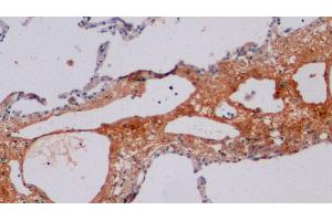 Detection of CTXI in Human Lung Tissue using Polyclonal Antibody to Cross Linked C-Telopeptide Of Type I Collagen (CTXI)