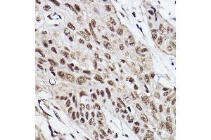 Immunohistochemistry of paraffin-embedded human esophageal cancer using UBE2B Rabbit mAb (ABIN7271173) at dilution of 1:100 (40x lens).