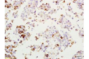Formalin-fixed and paraffin embedded rat lung melanoma labeled with Anti-MAGE-1 Polyclonal Antibody, Unconjugated  at 1:200, followed by conjugation to the secondary antibody and DAB staining (MAGEA1 anticorps  (AA 101-200))