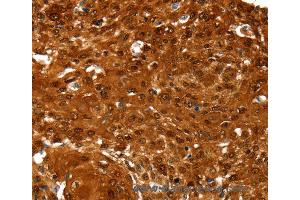 Immunohistochemistry of Human esophagus cancer using NCOR1 Polyclonal Antibody at dilution of 1:60 (NCOR1 anticorps)