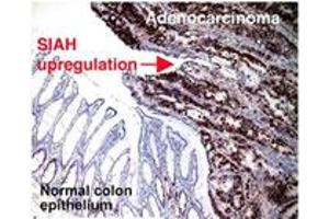 Immunohistochemical staining of SIAH2 on human colorectal adenocarcinoma with SIAH2 monoclonal antibody, clone 24E6H3 . (SIAH2 anticorps  (AA 1-100))