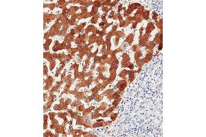 Immunohistochemical analysis of paraffin-embedded Human hepatocarcinoma tissue using C performed on the Leica® BOND RXm.