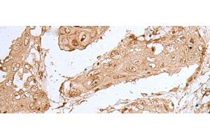 Immunohistochemistry of paraffin-embedded Human esophagus cancer tissue using HOXC9 Polyclonal Antibody at dilution of 1:35(x200) (HOXC9 anticorps)