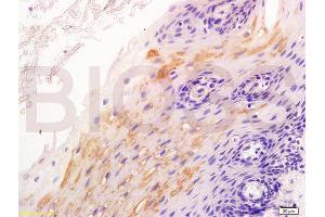 Formalin-fixed and paraffin embedded human esophageal cancer labeled with Anti-?