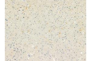 ABIN6260737 and ABIN6279257 at 1/100 staining human hepatocellular carcinoma by IHC-P. (CEACAM16 anticorps  (Internal Region))