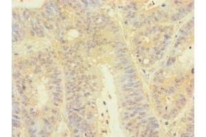 Immunohistochemistry of paraffin-embedded human colon cancer using ABIN7172830 at dilution of 1:100