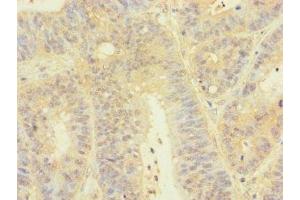 Immunohistochemistry of paraffin-embedded human colon cancer using ABIN7172830 at dilution of 1:100 (TGFB3 anticorps  (AA 24-300))