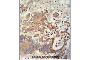 CHCHD2 antibody (Center) (ABIN654013 and ABIN2843939) immunohistochemistry analysis in formalin fixed and paraffin embedded human colon carcinoma followed by peroxidase conjugation of the secondary antibody and DAB staining. (CHCHD2 anticorps  (AA 74-103))