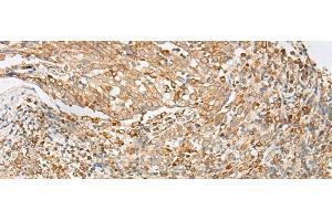 Immunohistochemistry of paraffin-embedded Human cervical cancer tissue using MBOAT4 Polyclonal Antibody at dilution of 1:30(x200) (MBOAT4 anticorps)