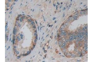 Detection of PKM2 in Human Prostate Tissue using Polyclonal Antibody to Pyruvate kinase isozymes M2 (PKM2)