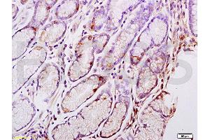 Formalin-fixed and paraffin embedded human gastric carcinoma tissue labeled with Anti-CENPA Polyclonal Antibody, Unconjugated (ABIN750113) at 1:200 followed by conjugation to the secondary antibody and DAB staining (CENPA anticorps  (AA 65-140))