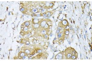 Immunohistochemistry of paraffin-embedded Human liver cancer using CALR Polyclonal Antibody at dilution of 1:100 (40x lens). (Calreticulin anticorps)
