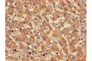 Immunohistochemistry of paraffin-embedded human liver cancer using ABIN7153167 at dilution of 1:100 (FFAR3 anticorps  (AA 280-346))