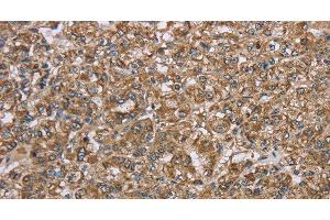 Immunohistochemistry of paraffin-embedded Human prostate cancer using CERS4 Polyclonal Antibody at dilution of 1:35