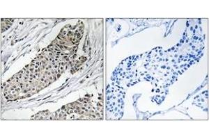 Immunohistochemistry analysis of paraffin-embedded human breast carcinoma tissue, using KCNAB3 Antibody.