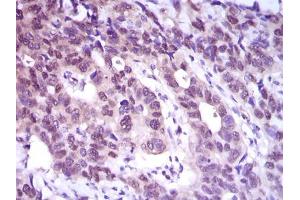 Immunohistochemical analysis of paraffin-embedded esophageal cancer tissues using ACLY mouse mAb with DAB staining.