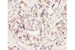 IHC-P: VEGF antibody testing of human lung cancer tissue (VEGFA anticorps  (AA 27-191))