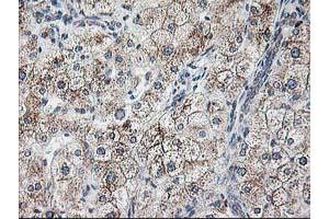 Immunohistochemical staining of paraffin-embedded Human liver tissue using anti-RPN1 mouse monoclonal antibody. (RPN1 anticorps)