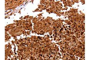 The image on the left is immunohistochemistry of paraffin-embedded Human lung cancer tissue using ABIN7128966(CLEC4A Antibody) at dilution 1/15, on the right is treated with fusion protein. (CLEC4A anticorps)