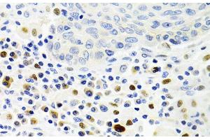 Immunohistochemistry of paraffin-embedded Human lung cancer using GEMIN2 Polyclonal Antibody at dilution of 1:100 (40x lens). (SIP1 anticorps)