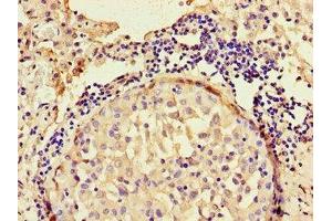 Immunohistochemistry of paraffin-embedded human lung cancer using ABIN7144308 at dilution of 1:100 (Anoctamin 4 anticorps  (AA 1-200))