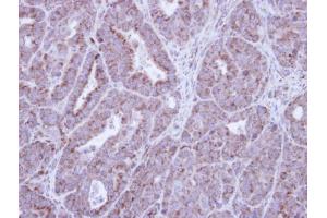 IHC-P Image Immunohistochemical analysis of paraffin-embedded NCIN87 Xenograft , using HAX1, antibody at 1:100 dilution.