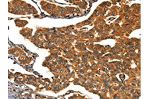 The image on the left is immunohistochemistry of paraffin-embedded Human breast cancer tissue using ABIN7190038(CACNA1E Antibody) at dilution 1/15, on the right is treated with synthetic peptide. (CACNA1E anticorps)