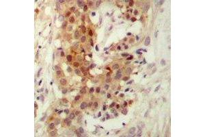 Immunohistochemical analysis of PKC iota/zeta staining in human breast cancer formalin fixed paraffin embedded tissue section. (PKC iota/zeta anticorps)