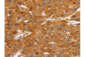 The image on the left is immunohistochemistry of paraffin-embedded Human liver cancer tissue using ABIN7130217(MED22 Antibody) at dilution 1/40, on the right is treated with fusion protein. (MED22 anticorps)