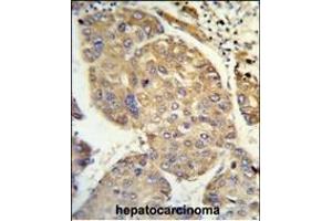 Formalin-fixed and paraffin-embedded human hepatocarcinoma reacted with PHACTR2 Antibody (N-term), which was peroxidase-conjugated to the secondary antibody, followed by DAB staining. (PHACTR2 anticorps  (N-Term))