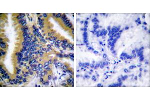 Peptide - +Immunohistochemical analysis of paraffin-embedded human breast carcinoma tissue using BIK (Ab-33) antibody (#B0053). (BIK anticorps  (Thr33))
